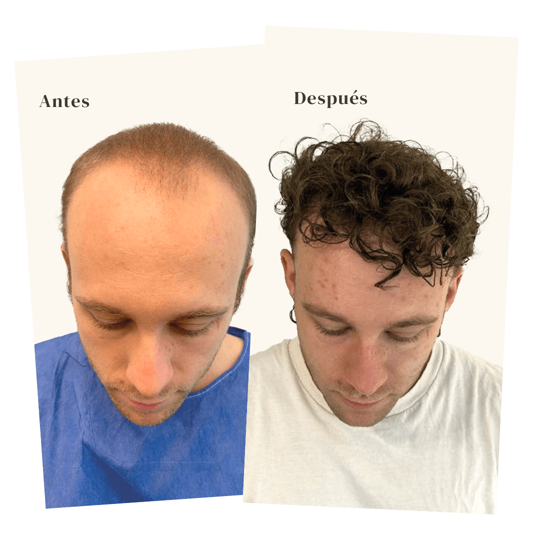 resultado injerto capilar clinicas be